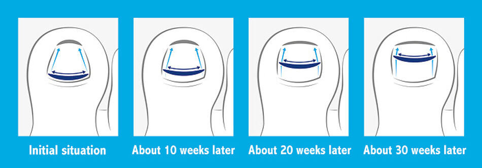 Image of four stages of Onyfix correcting a toe nail through natural growth, from initial conditions to 30 weeks after