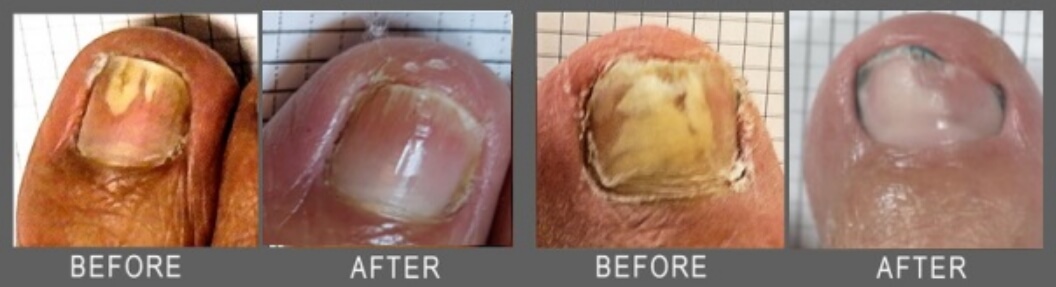 Image of two toe nails before and after treatment, showing much improvement